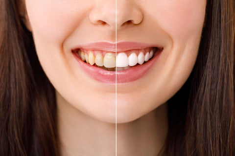 Foods That Naturally Whiten Your Teeth: A Natural Approach to a Brighter Smile