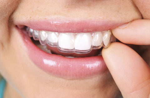 Can Clear Aligners Work as Fast as Braces? The Truth About Treatment Time
