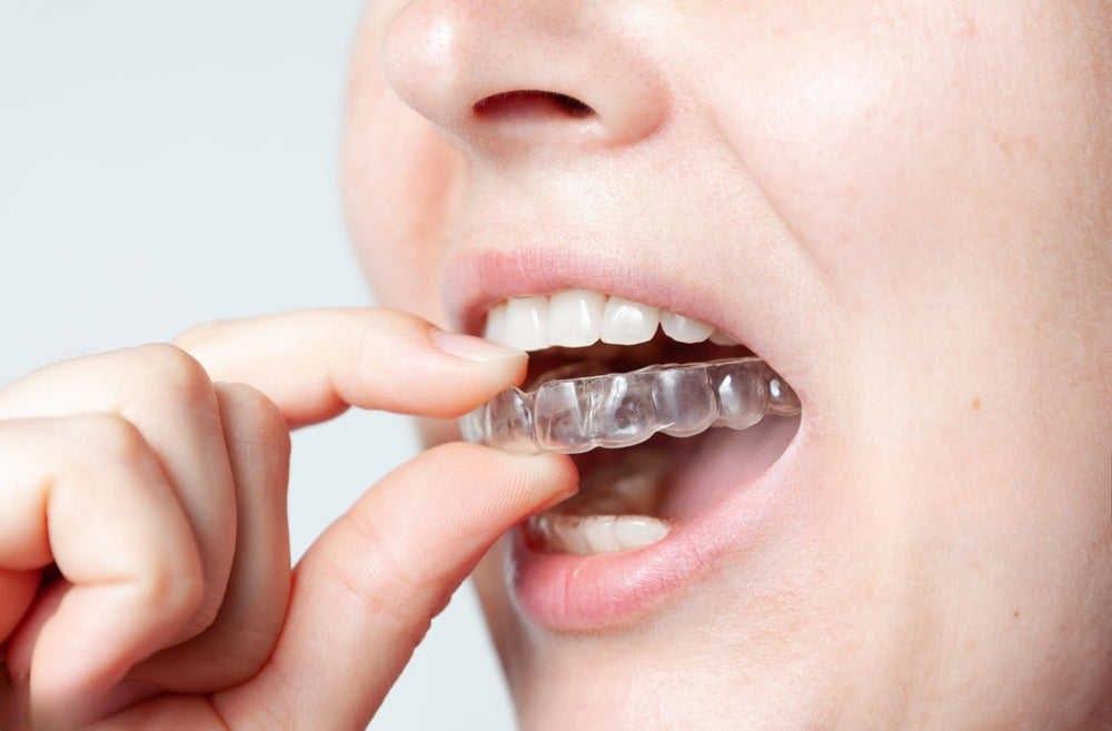 Top 10 Reasons to Choose Invisible Aligners for Your Smile Transformation