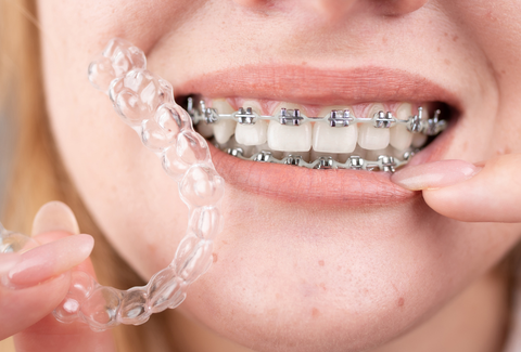 Top Reasons Australians Switch From Braces to Aligners