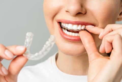 What Are Dental Aligners and How Do They Straighten Your Teeth?