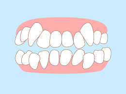 The Role of Clear Aligners in Addressing Crowded Teeth