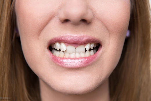 How Clear Aligners Correct Overbites: A Step-by-Step Process