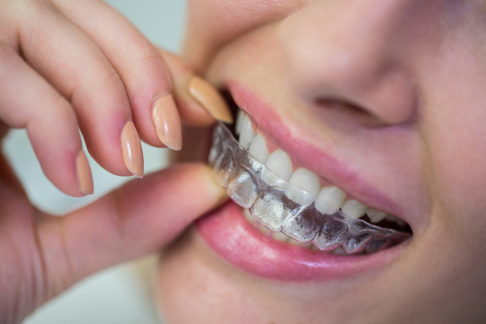 Collins Retainer Why Retainers Are Essential After Aligners | Long-Term Smile Care ...