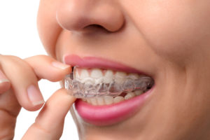 Can Invisible Braces Fix All Types of Teeth Misalignments?