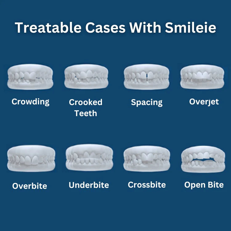 Smileie Daytime Dual Arch Clear Aligners $1160 ($1360) + more $200 off with code